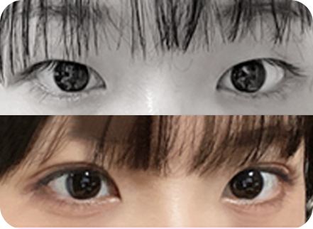 아이디병원 - 10대 눈성형 - 쌍액 & 쌍테 부작용 - 눈성형