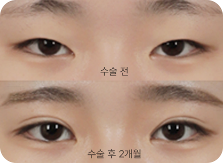 아이디병원 - 10대 눈성형 - 성형하기엔 너무 빠르지 않나요? 10대 학생들도 눈 성형은 가능 - 눈성형