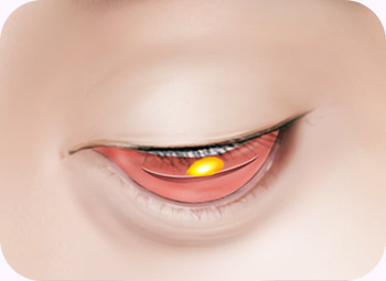 아이디병원 - id 눈 밑 지방 재배치 수술방법 -  눈 안쪽 결막을 절개해 불필요한 지방만을 제거 - 눈성형