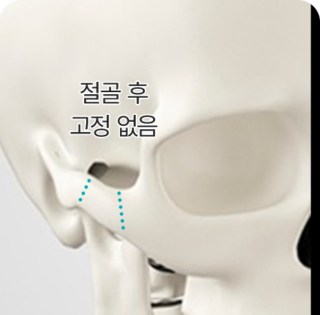 아이디병원 - id 퀵 광대축소 - 기존 광대 축소는 절골 후 고정 생략으로 뼈가 벌어지거나 광대 축소 효과 미비 - 안면윤곽