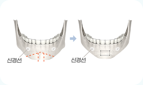 아이디병원 - 턱끝축소 수술방법 - 턱끝이 뭉툭하고 넓어 보이는 경우, T모양으로 절골 후 가운데 뼈를 빼내어 턱 끝을 좁혀줍니다 - 안면윤곽