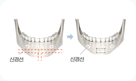 아이디병원 - 턱끝축소 수술방법 - 턱끝이 길어 얼굴이 길어 보이는 경우, 샌드위치 모양으로 절골하여 턱끝 길이와 너비를 축소합니다 - 안면윤곽