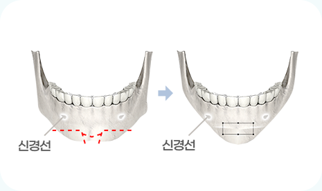 아이디병원 - 턱끝축소 수술방법 - 턱이 짧고 뭉툭한 경우, 뼈 이식 없이 자가 뼈로 길이 연장하여 비율 맞춥니다 - 안면윤곽