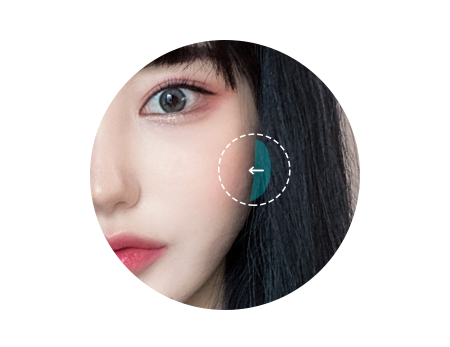 아이디병원 - id 광대축소 - 돌출된 광대를 밀어 넣고 앞광대 입체감을 살려 굴곡 없이 매끄러운 라인으로 - 안면윤곽