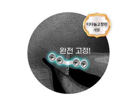 아이디병원 - id 광대축소 - 아이디가 개발한 티타늄 고정핀으로 튼튼하게 완전 고정 - 안면윤곽