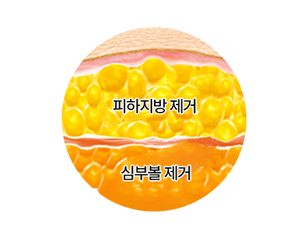 아이디병원 - id 사각턱축소 - 심부볼과 피하지방을 슬림하게 제거하여 더 갸름해지는 V라인 - 안면윤곽